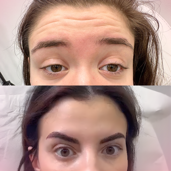 Full-Face Revamp with Botox – £299