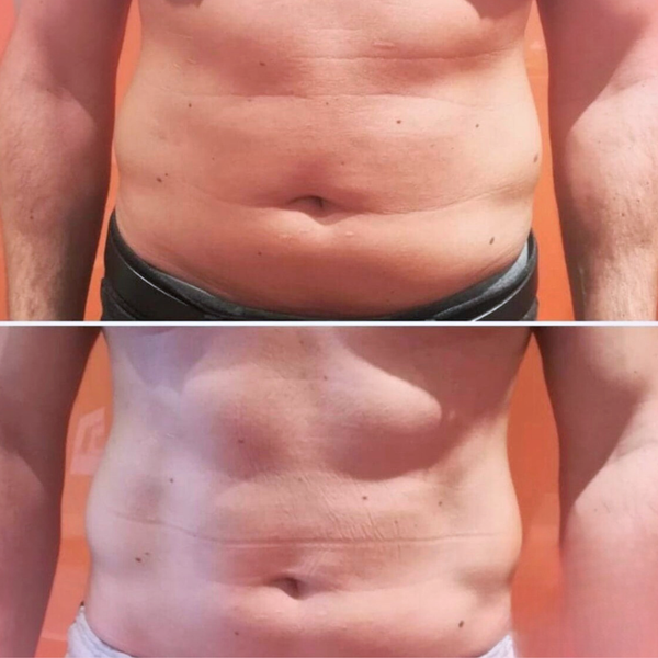 Fat Dissolve – 6 Sessions for £499
