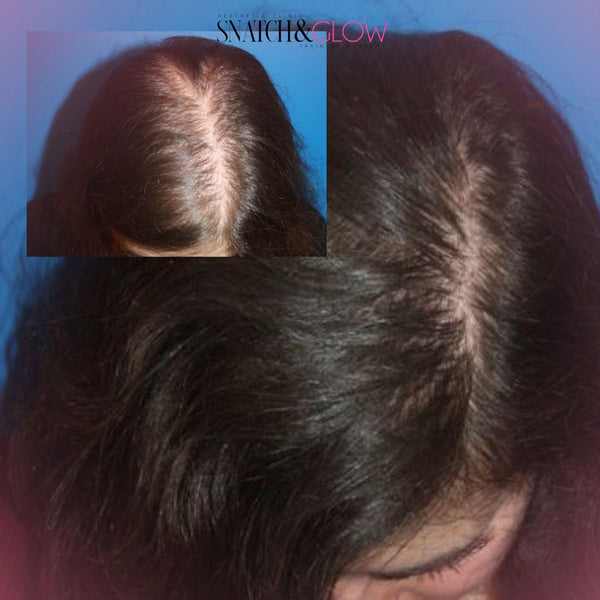 PRP Hair Revival – 6 Sessions for £549