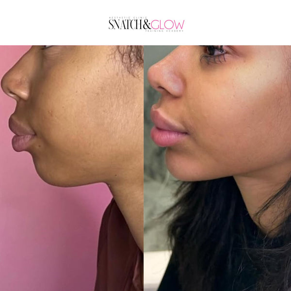 Facial Contouring Package – 3ml £199