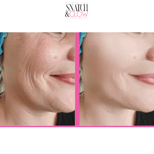Anti-Wrinkle Injections vs Skin Boosters: Which One Do You Really Need?