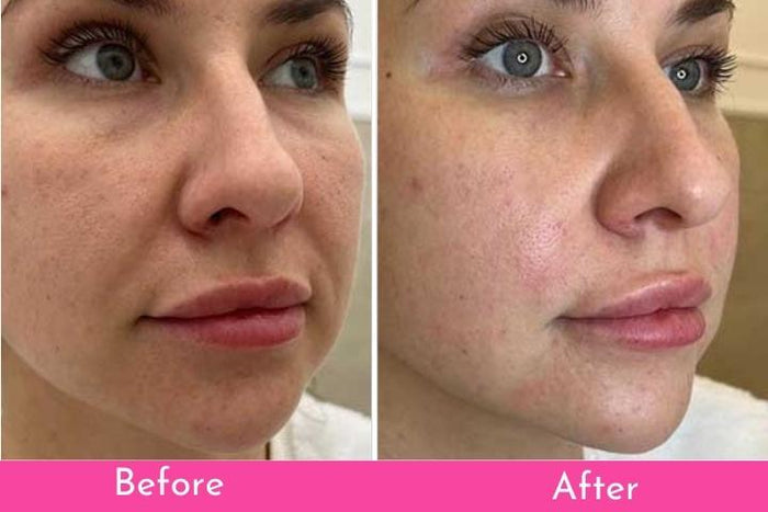 PDO Threads: The Non-Surgical Facelift That Actually Works 👀