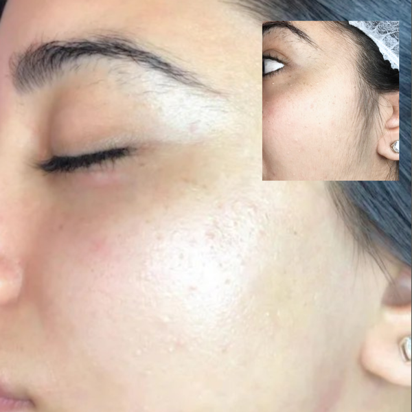 Dermaplaning Course. Learn Exfoliation & Peach-Fuzz Removal Techniques | Snatch & Glow Academy