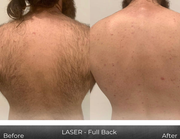 Laser Hair Removal- FULL BODY