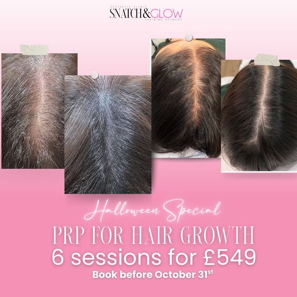 PRP Hair Revival – 6 Sessions for £549