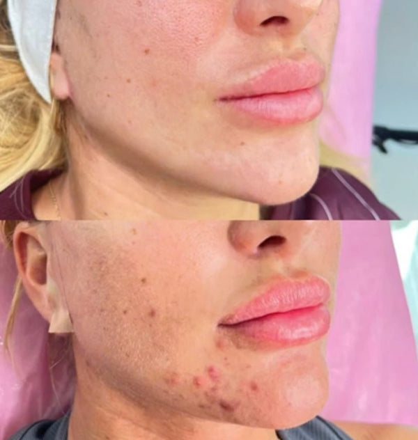 Microneedling “Glass Skin” Package – 3 Sessions for £185
