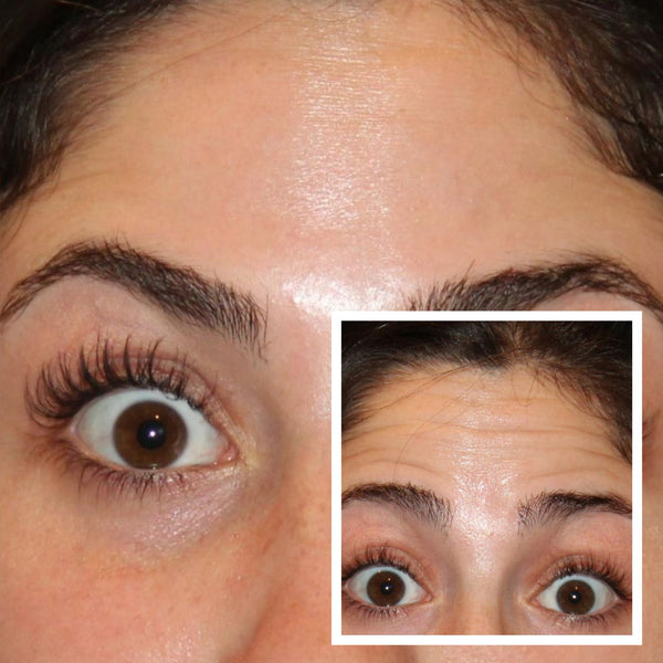 Botox 3 Areas – £194