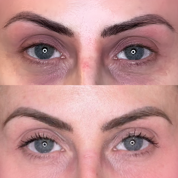 Polynucleotides & Skin Boosters – 3 Sessions for £400