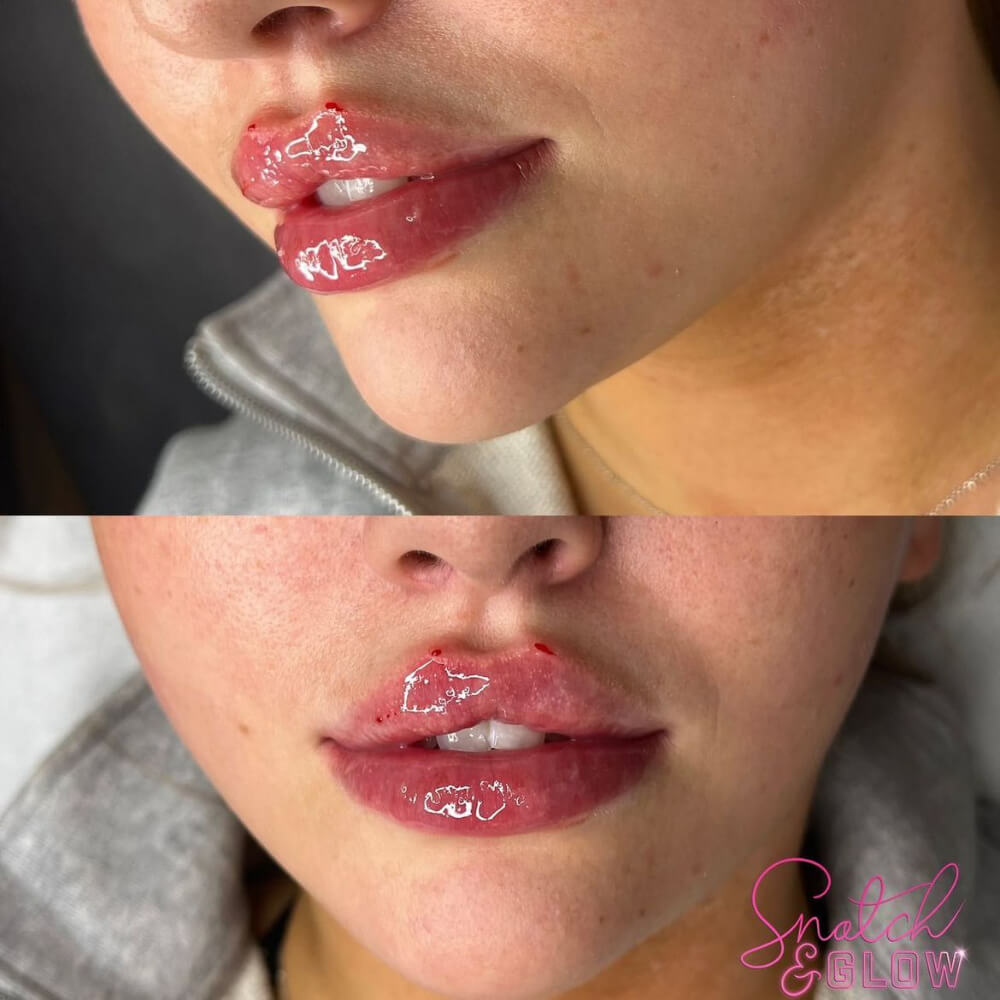 1.1ml Lip Augmentation Russian or Classic Style