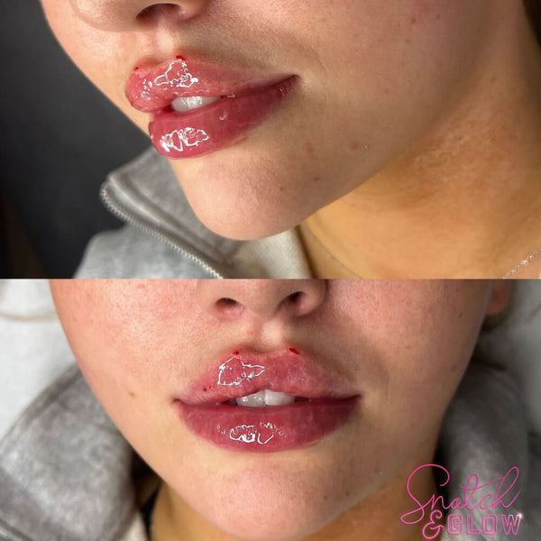 1.1 ml Russian Lip Filler