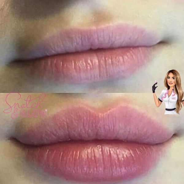 1ml Lip Augmention & Lip Flip - Any Style