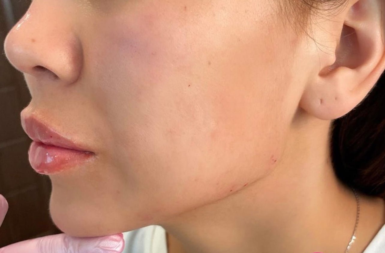 8ML 8 Point Facelift & Botox Model Offer