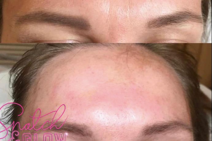 Freezer Botox Botox (3 Areas) Forehead Full Freeze - Snatch and Glow London
