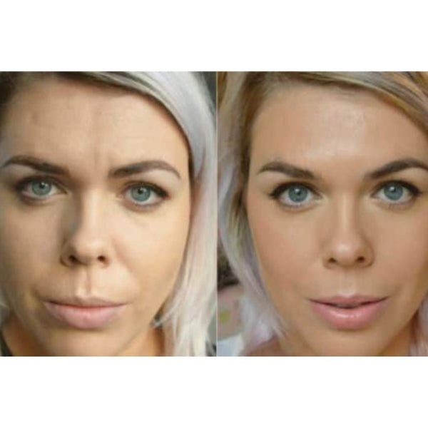 Botox Correction (New Clients from Elsewhere)