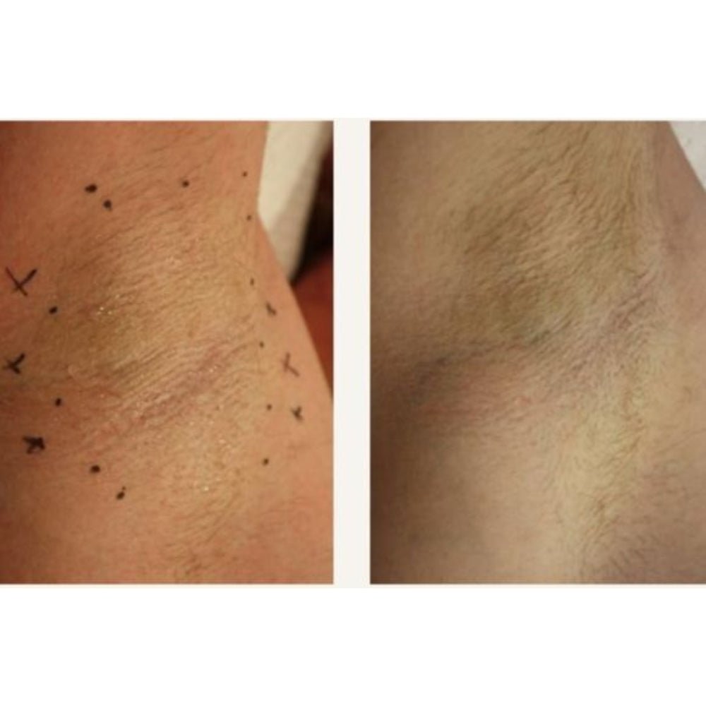 Botox for Hyperhydrosis Sweat Patches Prevention