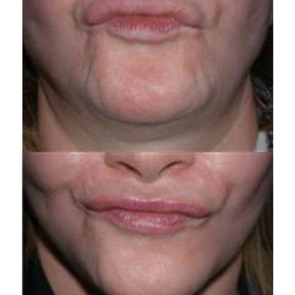 Botox Lower Face Rejuvenation