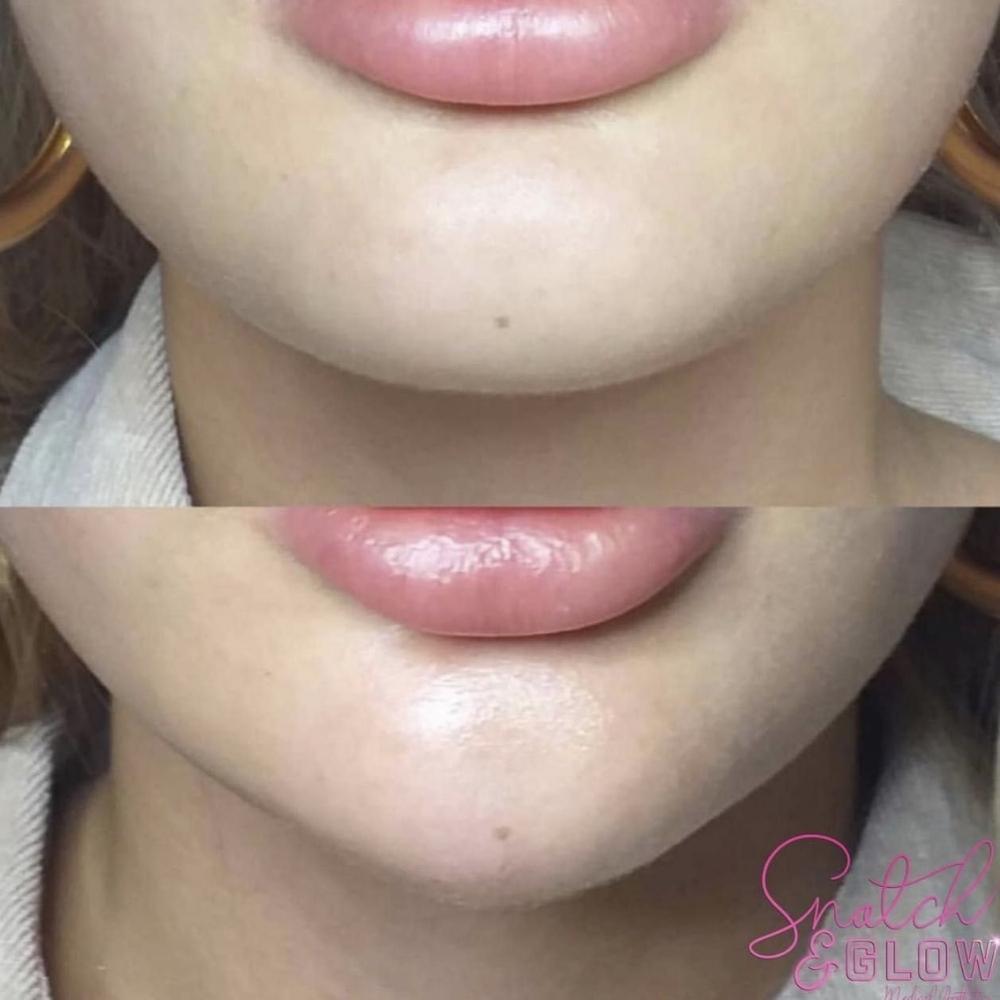 Chin Filler/ Profile Balancing