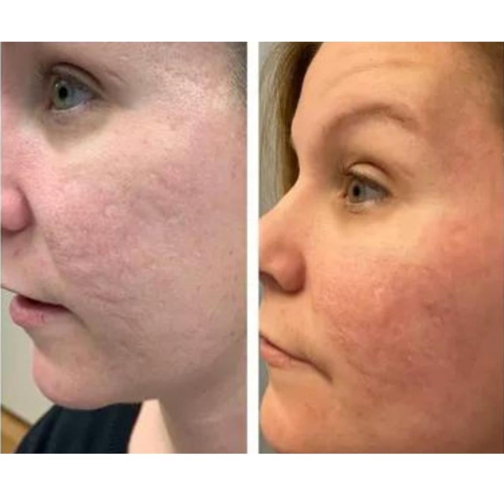 Dr Pen Microneedling Snatch and Glow London