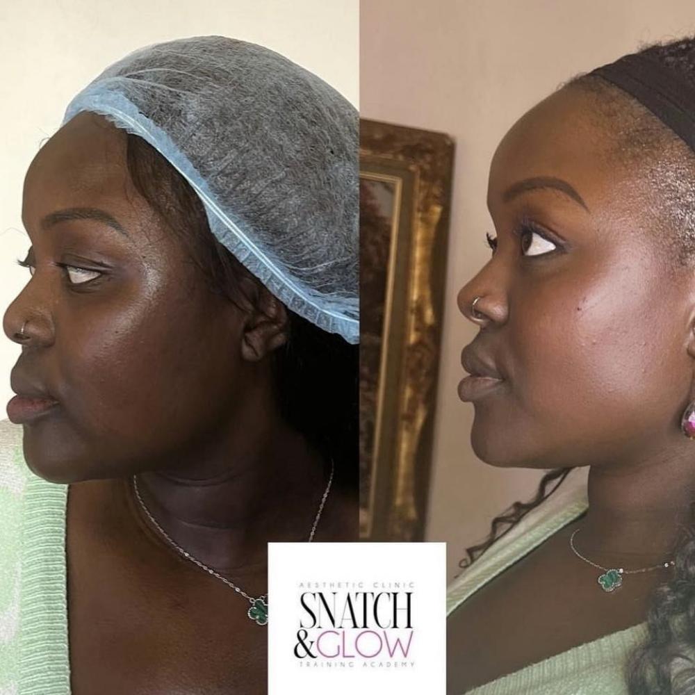 Facial Balancing, Contouring & Harmonisation