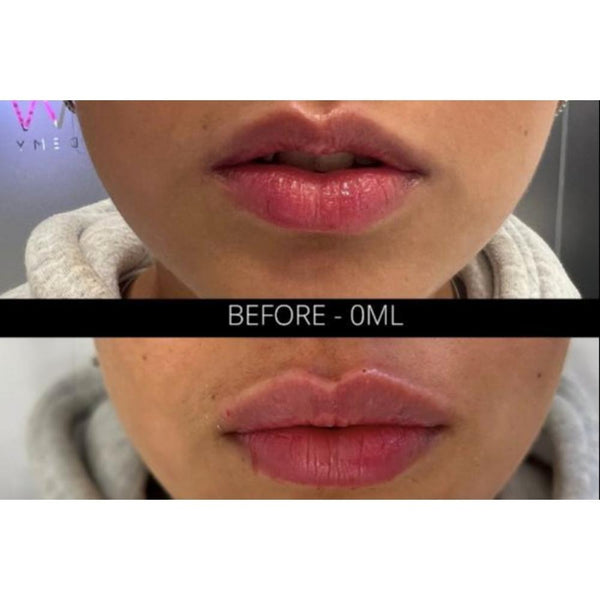A photo of  0.5 ml russian lip filler tretment in london