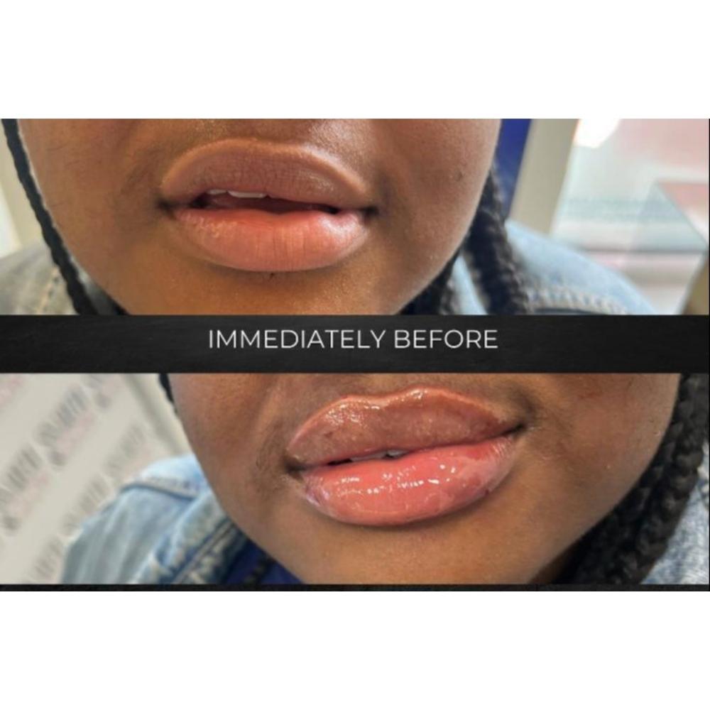 Lip Filler Juvederm - (1ML)