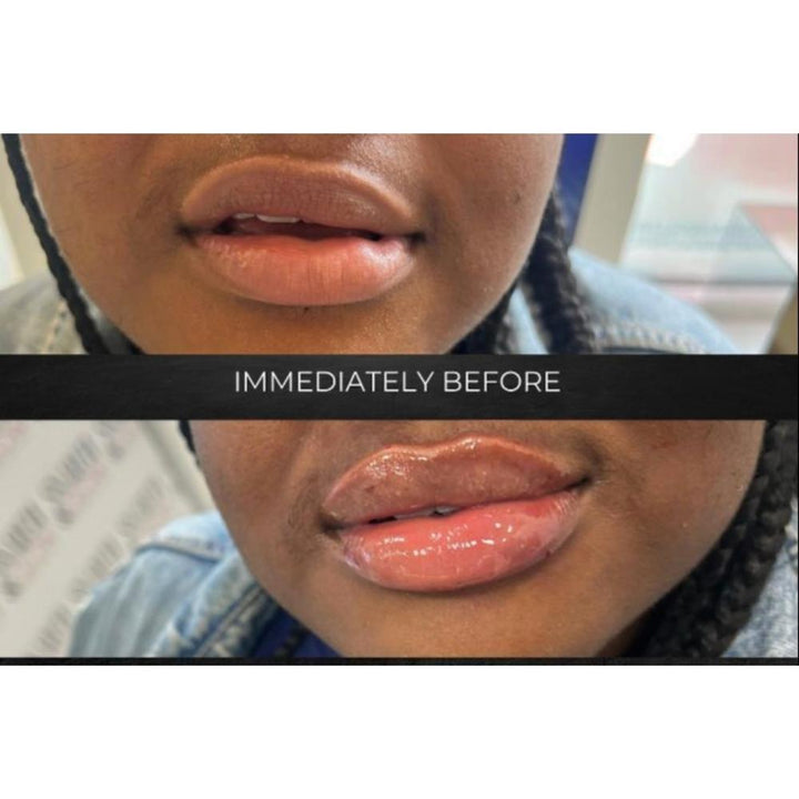 Lip Filler Juvederm