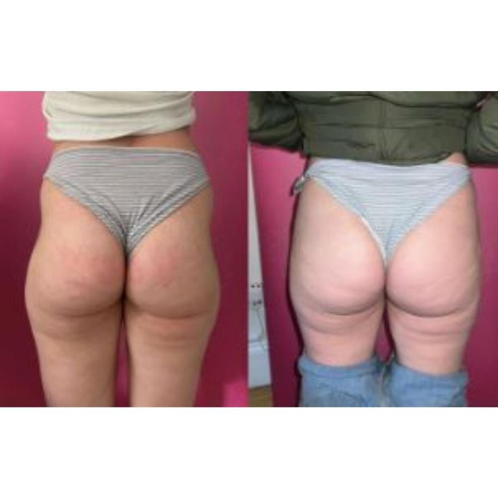 Bum Filler London Expert Non-Surgical BBL & Hip Fillers - Snatch and Glow London Bum Filler London Expert Non-Surgical BBL & Hip Fillers - Snatch and Glow London