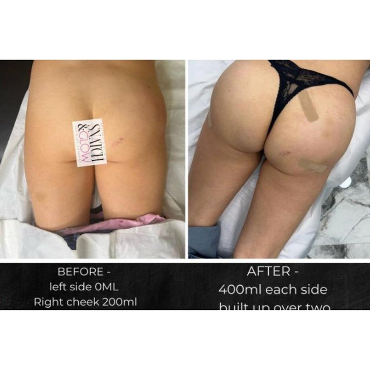 Natural looking non surgical bbl 🍑 #hipdips #hipdipfiller #hipdipfill