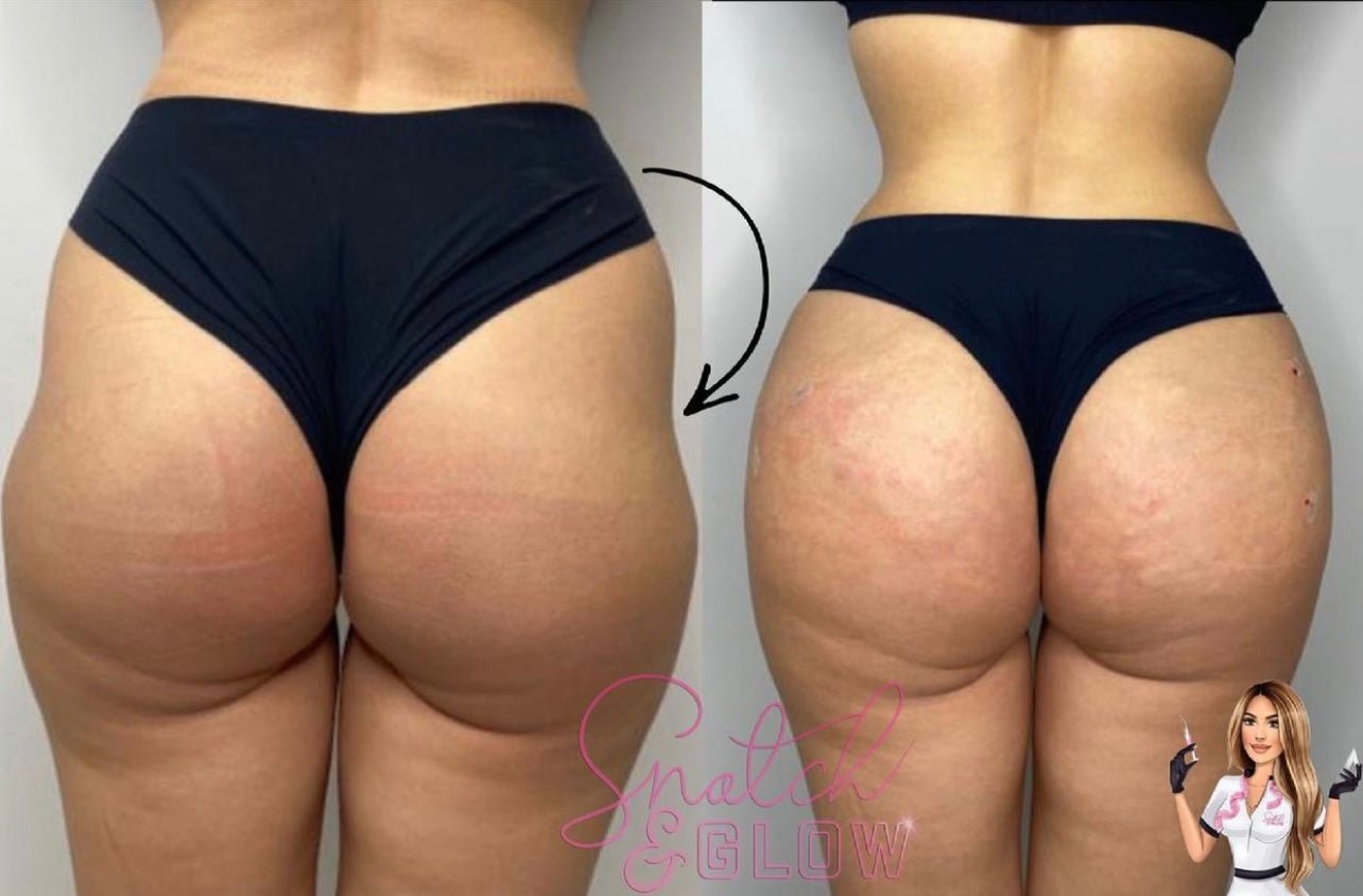 Consultation Deposit HIP DIP/ BUM Filler