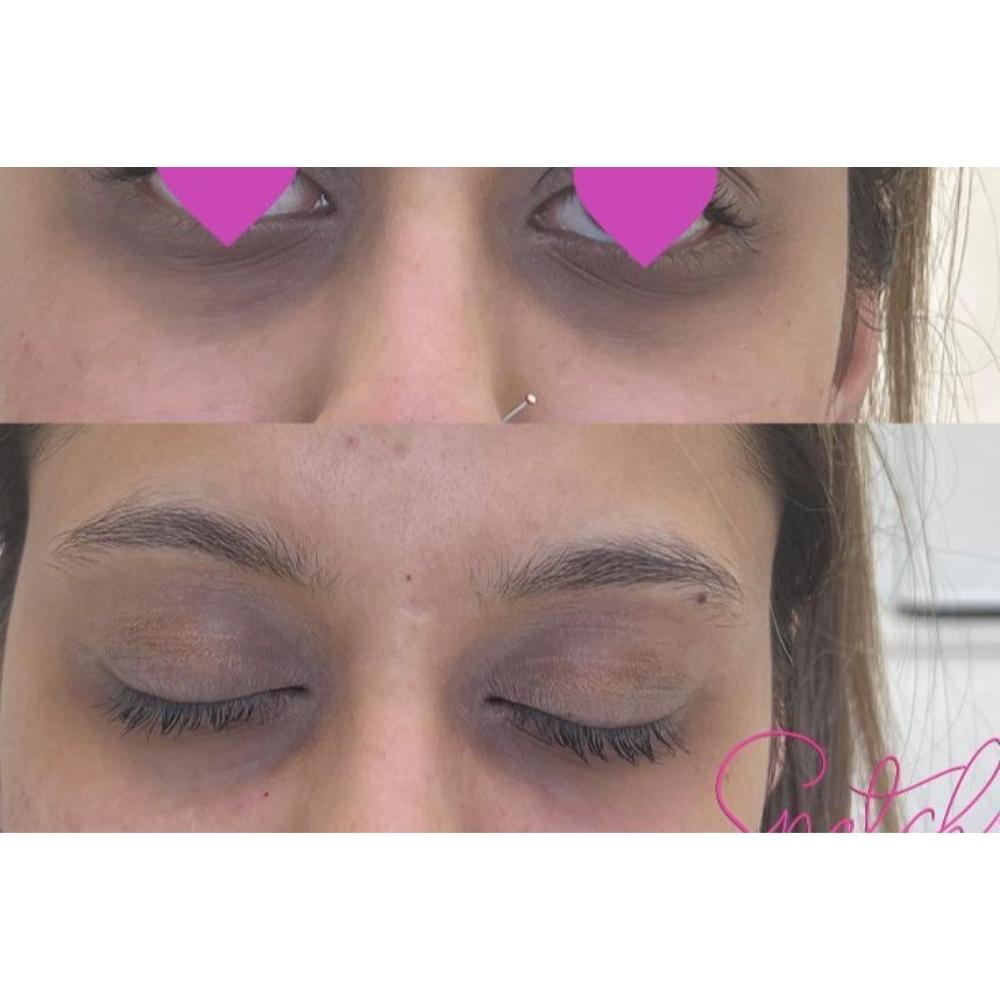 Sunekos Treatment – Rejuvenate Eyes, Reduce Dark Circles & Restore Periocular Brightness