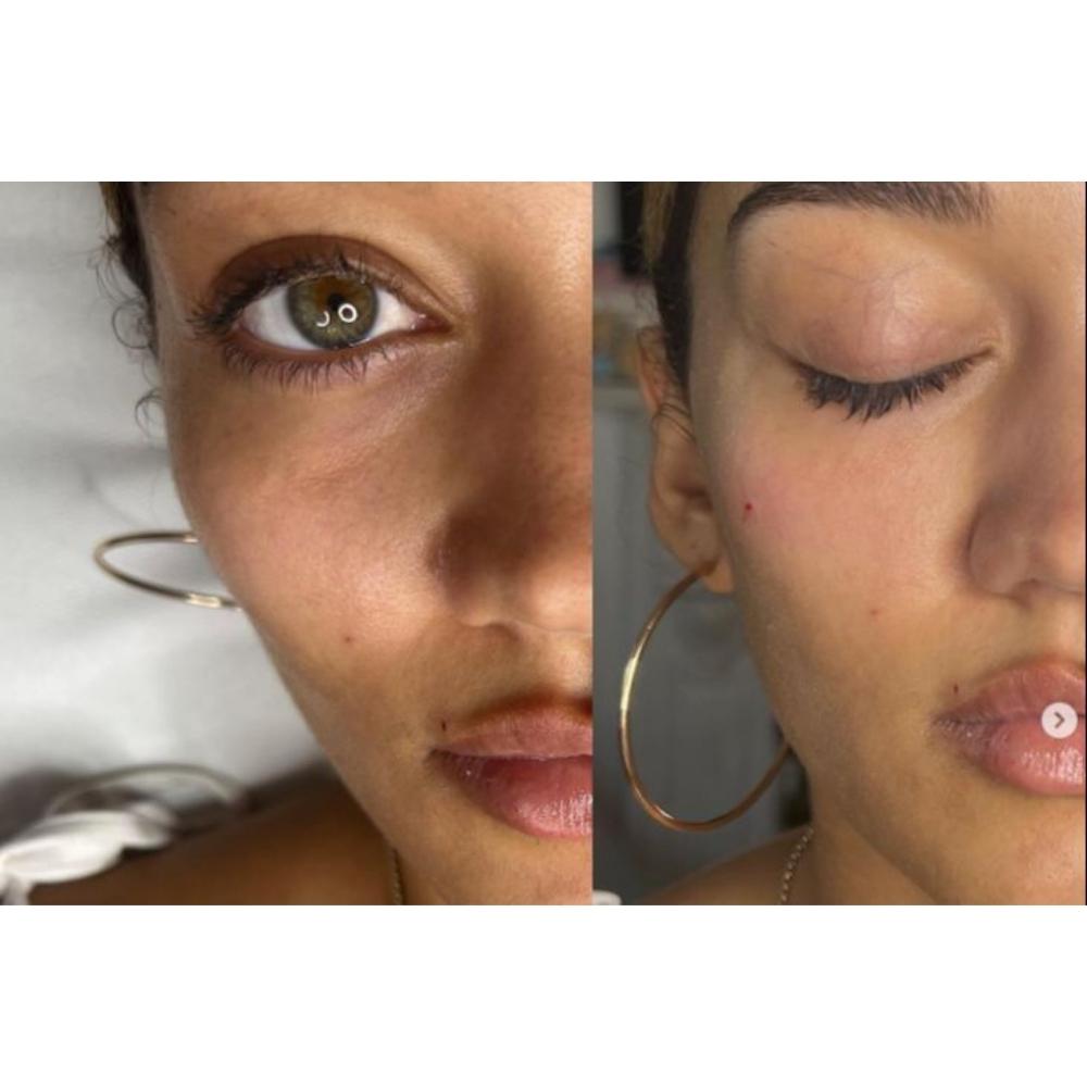 Tear Trough/Under Eye - Teosyal Resensity II